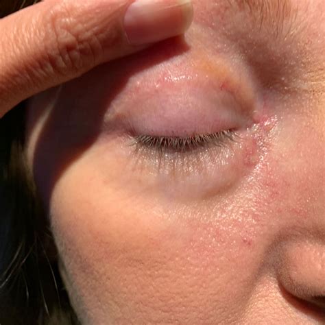 Eyelid Procedures | City West Eye Specialists