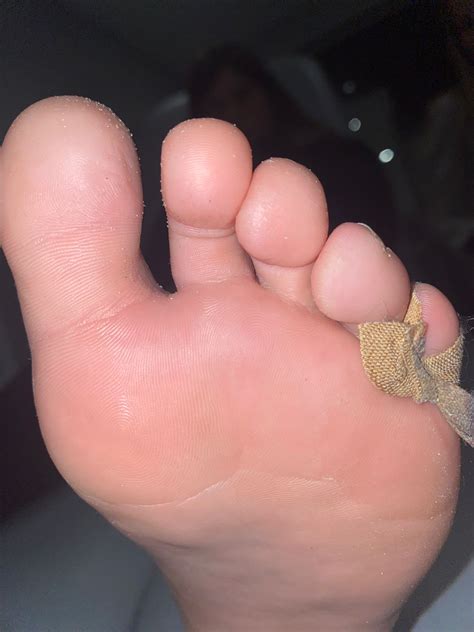 verruca treatment  swift    healthcare hub