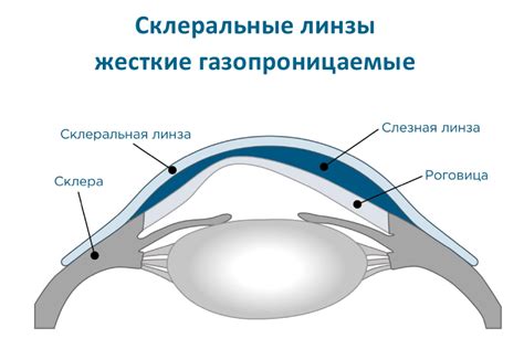 Жесткие газопроницаемые линзы - контактные линзы