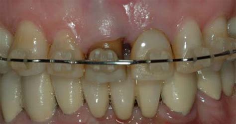 Slow Orthodontic Teeth Extrusion to Enhance Hard and Soft Periodontal ...