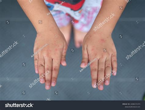 Rash On Hands Hand Foot Mouth Stock Photo 2206171373 | Shutterstock