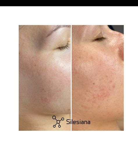 BioRePeel NYC | Chemical Peel Treatment | FAST Results