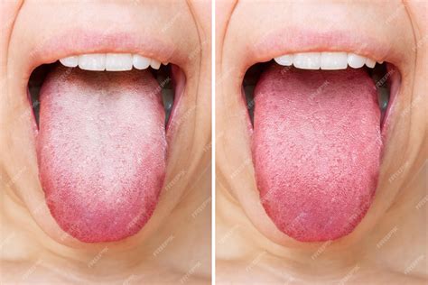 Premium Photo | Comparison of diseased tongue with white plaque and ...