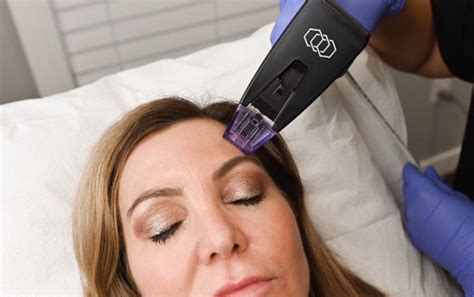 Stretch marks | Cellulite reduction treatment Micro-Needling with RF