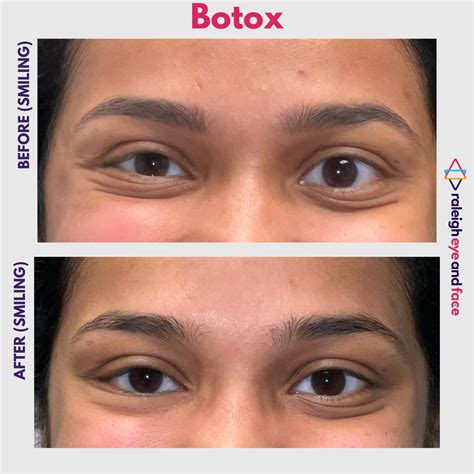 how to fix uneven eyes 5