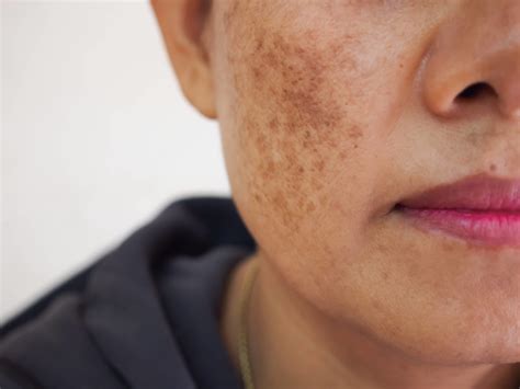 Smokers Skin Damage: 7 Ways Smoking Harms Your Skin Health