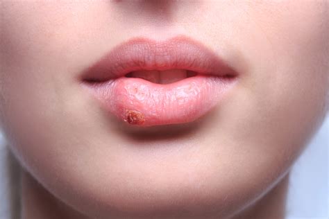 You probably have herpes, says the WHO - Euractiv