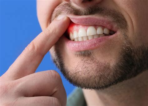 how long does it take for cavities to form
