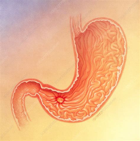 stomach ulcer stock image  science photo library