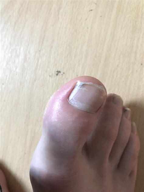 How did this happen? I woke up and my toe was burning : r/medical
