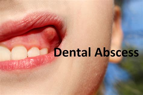 [DIAGRAM] Diagram Of Abscess - MYDIAGRAM.ONLINE