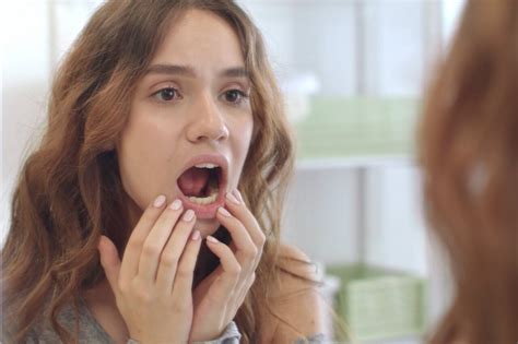 Discover the Best Home Remedy for Canker Sore on Tongue: Expert Tips ...