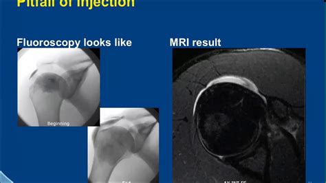 Shoulder Arthrography Pitfalls - YouTube