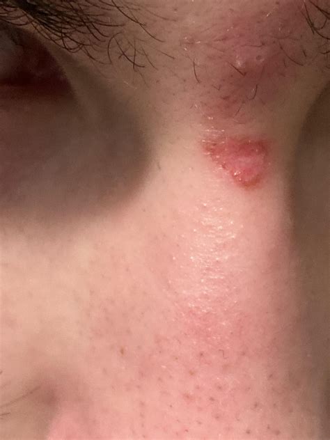 Warning: This Unbelievable Blackhead Removal 2024 Method Is Addictive! Image 8