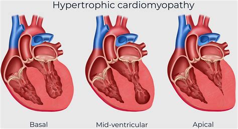 Invasive Management of Hypertrophic Cardiomyopathy With Clinically ...