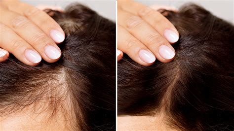 hair loss treatments  medications goodrx
