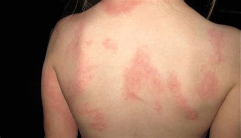 10 Signs of Hives You Need to Watch Out – New Life Ticket