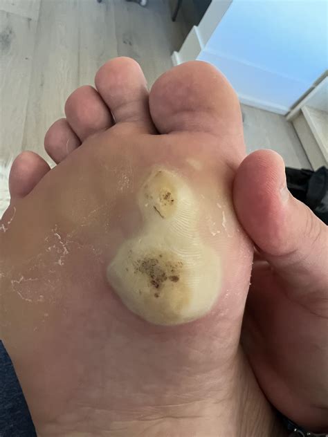 First time treating a finger wart - does this look like normal