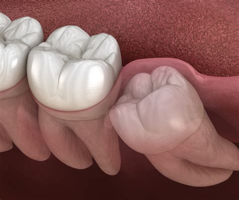 Arrancar O Dente Do Siso - Dentista para arrancar dente do siso em SP - Clínica Aline Resende