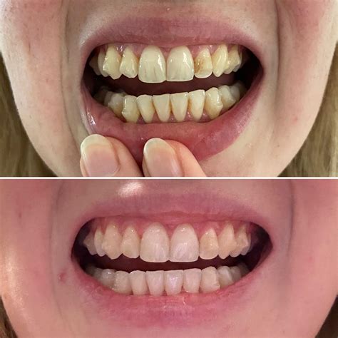 Before and after a hygienist clean today! 13 months into treatment and