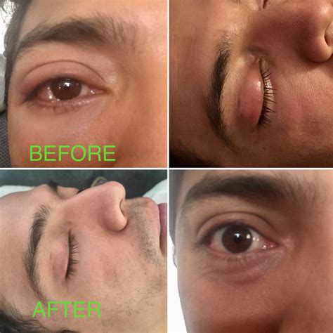 Swollen Upper Eyelid Stye
