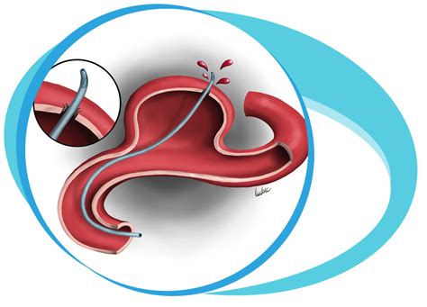 aneurysm coiling  iran medpersia medical tourism