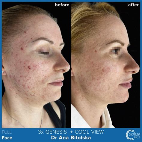 Ринопластика - Пластична хирургия - Derma-Act