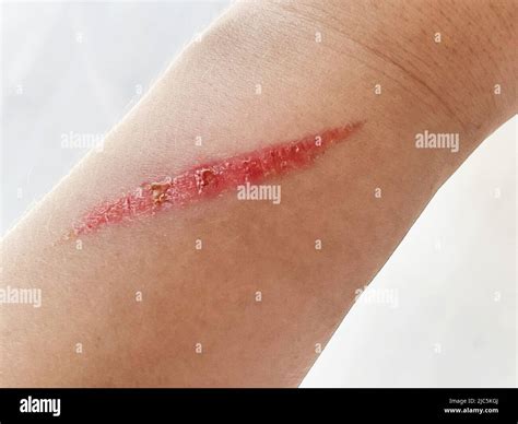Close up of burn scar on a woman's hand. The skin damage in first ...