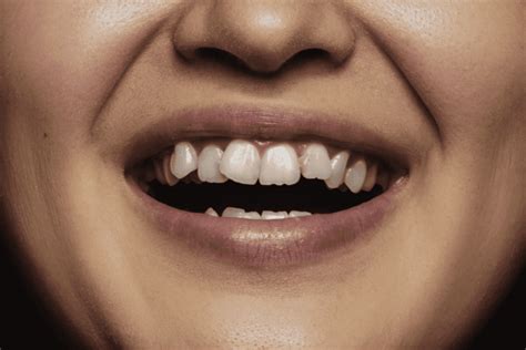 malocclusion   fix      qpior