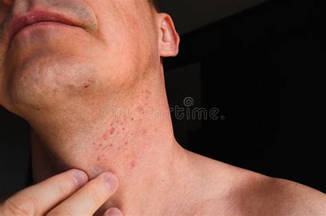 Skin Irritation after Shaving. Skin Irritation on Male Neck after