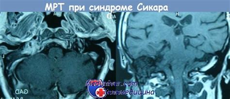 Синдром Сикара (Sicard) - синонимы, авторы, клиника