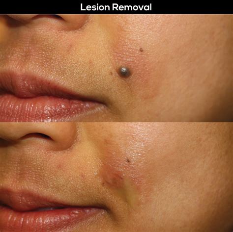 Lesion Removal Treatment - Perfect B