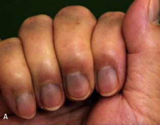 lunula  lunula fingernails