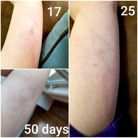 Confirmed Brown Recluse Bite : r/spiders