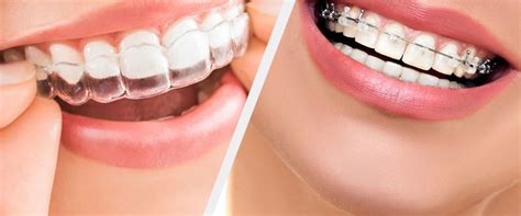 benefits  clear aligners