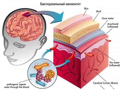 Вирусный менингит.