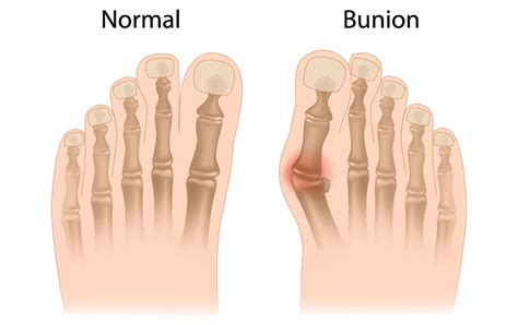 big toe pain elite sports medicine orthopedics orthopedics