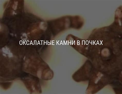 Оксалатные камни и песок в почках: причины образования, как вывести ...