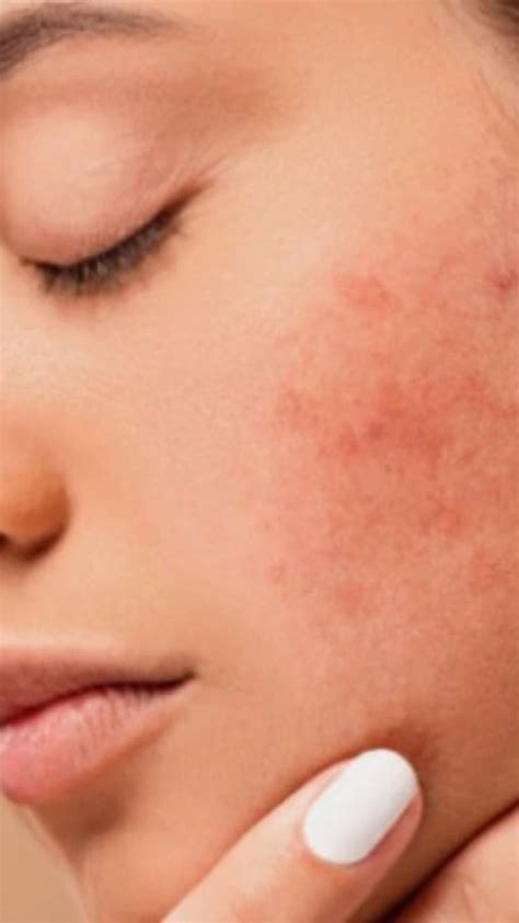 Pimples Causes | झोपण्याच्या या सवयींमुळे चेहऱ्यावर येतात पिंपल्स