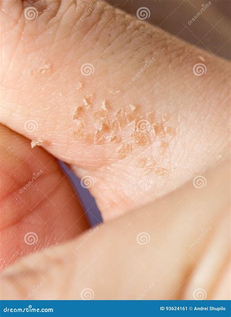 Fungus on the finger stock image. Image of closeup, uncomfortable