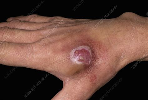 Pyogenic granuloma - Stock Image - C040/2270 - Science Photo Library