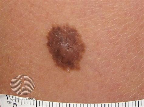 moles nevi  symptoms  evaluation  columbus ohio rixis