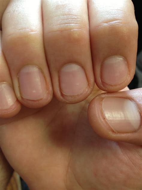fingernails cut too short