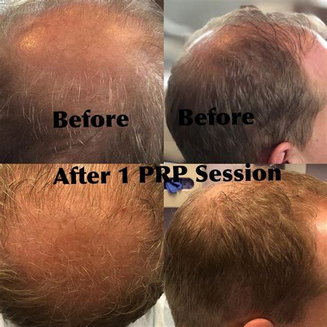 PRP Hair Restoration for Thinning Hair - Hinsdale Vein and Laser