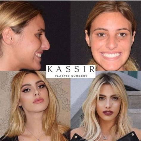 Cirujano de Lele Pons publica las fotos del antes y después de la youtuber