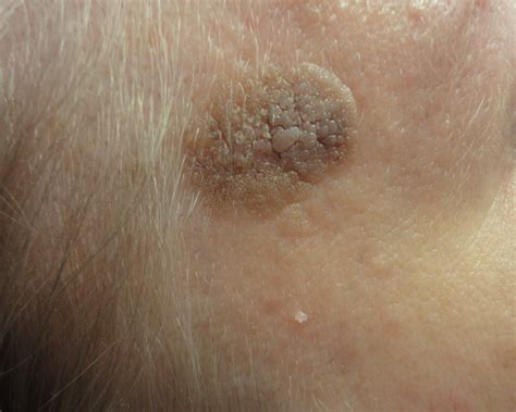 Flat Warts Warts Treatment