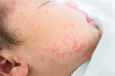 Сыпь на коже ребенка: потница, инфекция, аллергия? | MedAboutMe