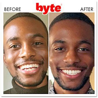 Byte Aligners: 21 Before & After Photos (Pics of Real Results!) | Byte ...