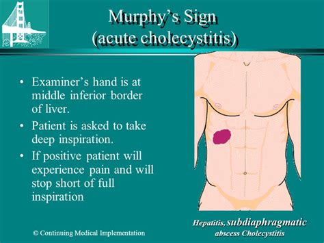 What is Murphy’s Sign? | Faculty of Medicine