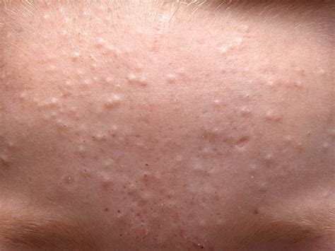 Whiteheads: Image, Causes, Treatment, Prevention